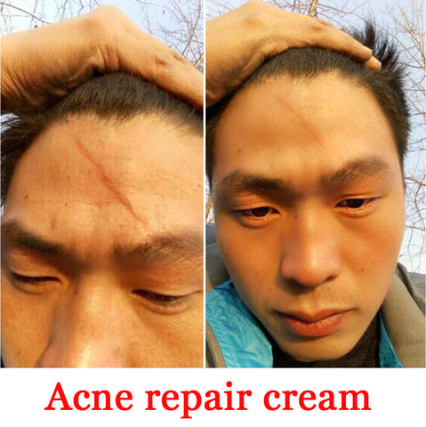 Scar Repair Skin Essential Oil Skin Care Natural Pure Remove Burn Scar Removal Scald Skin Repair Surgical Scars